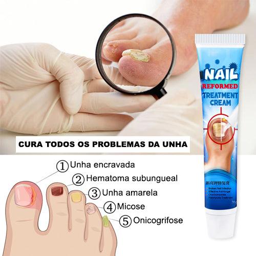 Nail Reformed - Tratamento de fungos e micose na unha - viya-stores