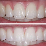 KIT de Reparação de Dentes HiSmile | Os dentes mais bonitos em poucos minutos!