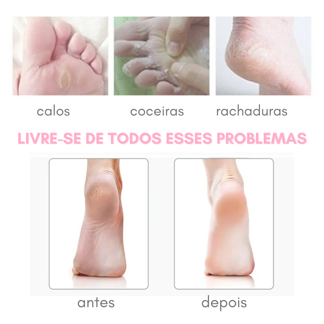 Removedor de Calos e Rachaduras dos Pés - Soft - viya-stores