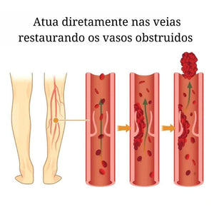 Adesivo removedor de Varizes – Varicose Veins - viya-stores