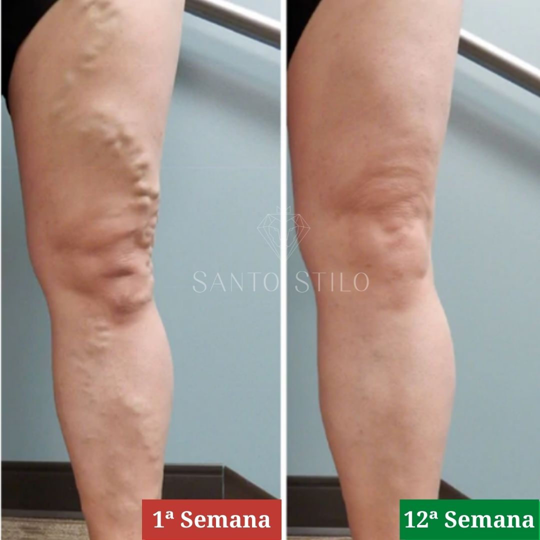 Adesivo removedor de Varizes – Varicose Veins - viya-stores