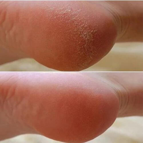 Pedicure Pro® Lixa de Pé Elétrica para Calos e Rachaduras nos Calcanhares, Removedor de Peles Mortas Profissional Em Casa - viya-stores