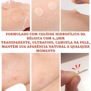 Kit Adesivo Curativo para Acne Dia e Noite - viya-stores